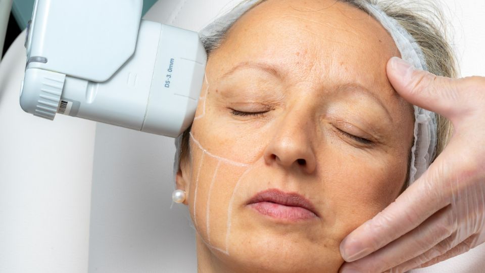 HIFU Ultherapy (High Intensity Focused Ultrasound)